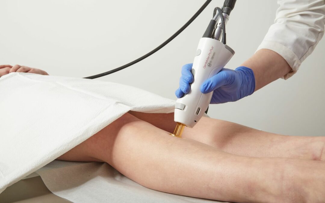 Epilation laser